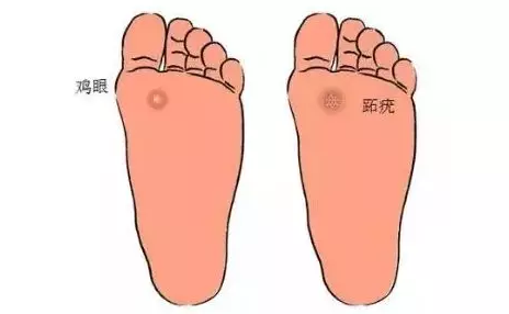 鸡眼到底是一种什么病