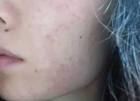 面部湿疹是怎么引起的