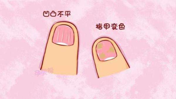 灰指甲的症状是什么