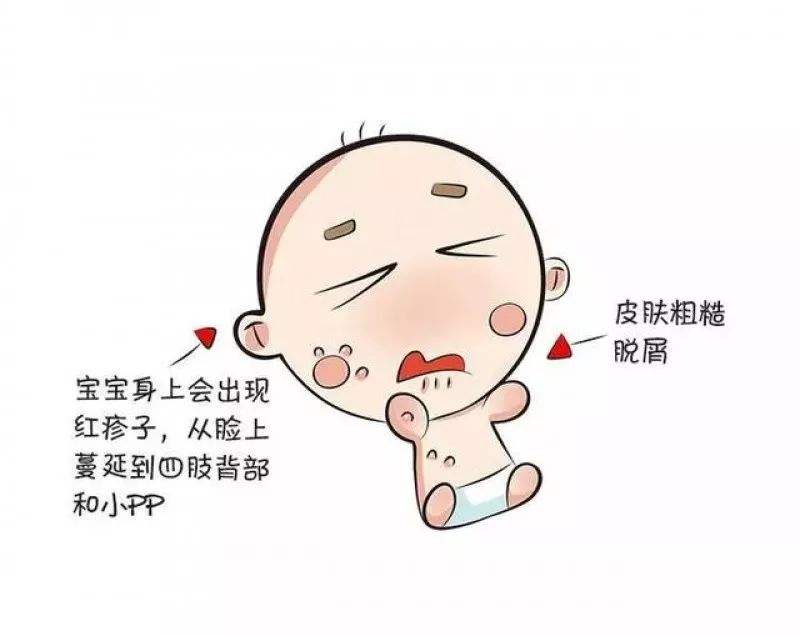 小孩子为什么会患上湿疹